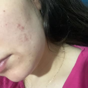 La Roche Posay Marka Ürünleri Sivilce Yaptı