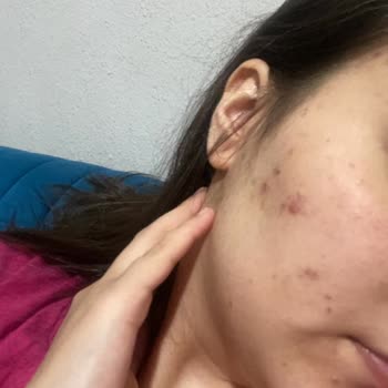 La Roche Posay Marka Ürünleri Sivilce Yaptı