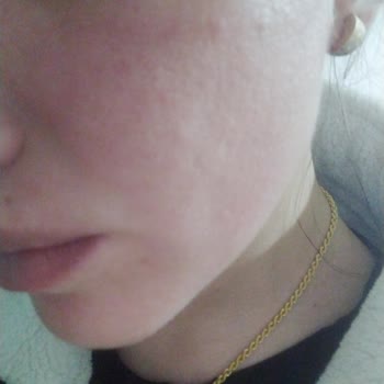 Yüzümü Mahveden Bioderma Ürünleri