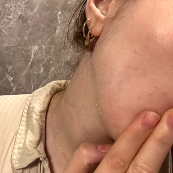 Yves Rocher Krem Yüzde Soyulma