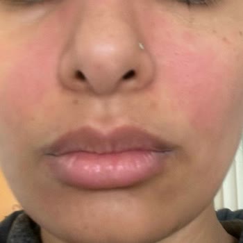 Rossmann Cilt Bakım Ürününden Beklenmedik Tepki!