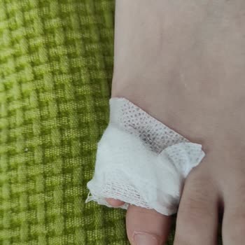 Ataşehir Medicana Atel Takacağım Deyip Sargı Bezi İle Sarması