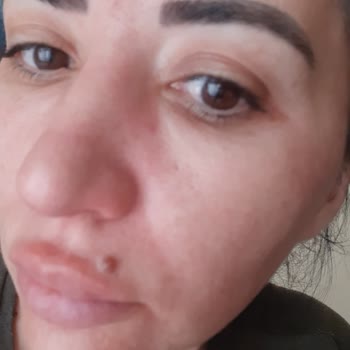 Rossmann Isına İntensiv Serum Vitamin C Yüzümü Mahvetti