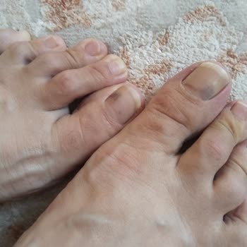 Adidas Ve Ayak Acısı