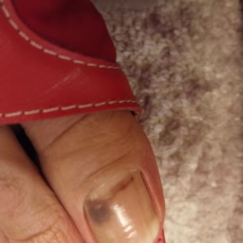 Adidas Ve Ayak Acısı