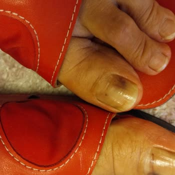 Adidas Ve Ayak Acısı