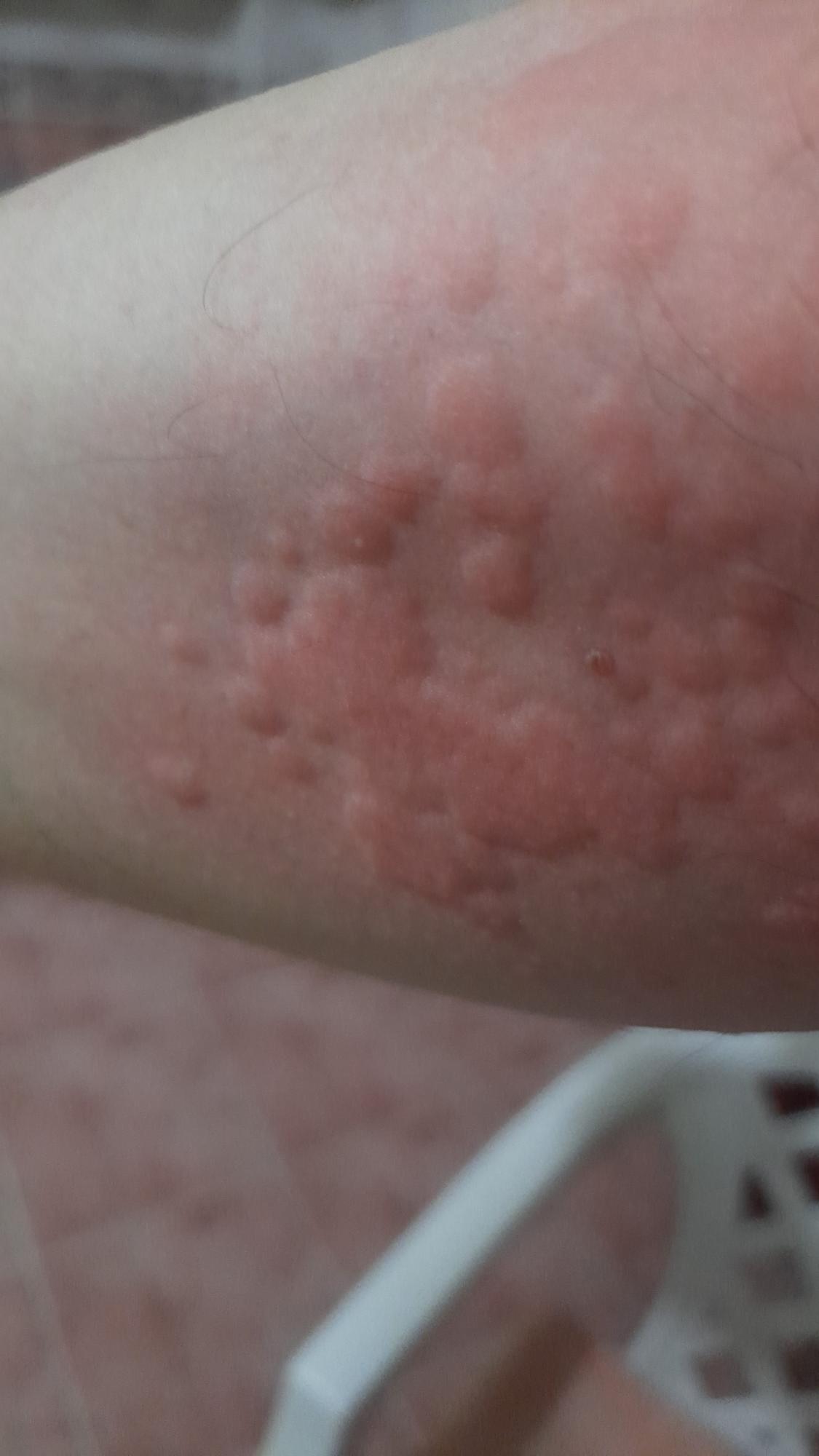Itchy Hives After Using Sensodyne Toothpaste! Xolvie