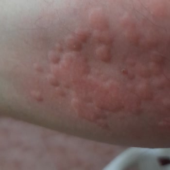 Itchy Hives After Using Sensodyne Toothpaste!