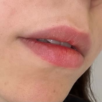 La Beaute By Buse Genç İşlem Sonrası Yüzde Lekelenme