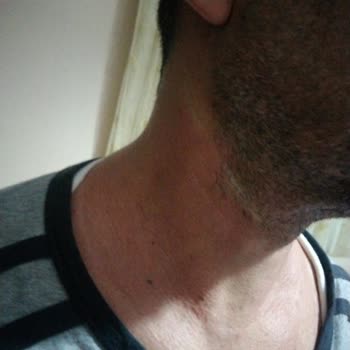 Sağlık Bakanlığı Thermoflex Kullanımı Sonrası Ciltte Yanma Ve Kızarıklık