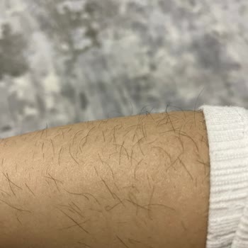 Emine Can Estetik Güzellik Lazer Epilasyon Sonuç Alamadım