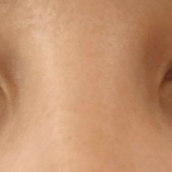 British Esthetic Botoks Mağduriyeti Ve İlgisizlik!