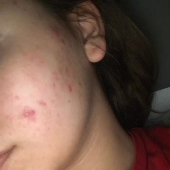 Seher Yıldız Beauty Yanlış Ürün Yanlış Tedavi 9 Bin₺ Ürün Satmak İçin Cildimi Mahvettiler