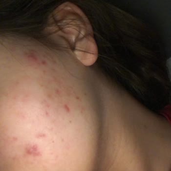 Seher Yıldız Beauty Yanlış Ürün Yanlış Tedavi 9 Bin₺ Ürün Satmak İçin Cildimi Mahvettiler