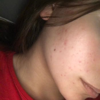 Seher Yıldız Beauty Yanlış Ürün Yanlış Tedavi 9 Bin₺ Ürün Satmak İçin Cildimi Mahvettiler