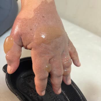 Özel Salihli Can Hastanesi Acil Serviste Yaşanan İhmalkarlık Ve Duyarsızlık