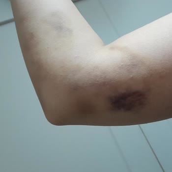 Beşiktaş Sait Çiftçi Devlet Hastanesi Acil Hemşiresi Kolumu Mahvetti