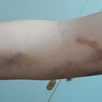 Beşiktaş Sait Çiftçi Devlet Hastanesi Acil Hemşiresi Kolumu Mahvetti