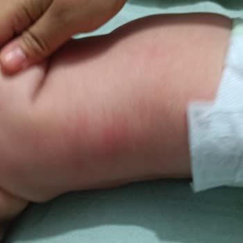 Bebem Natural Bebek Bezi Alerji Yaptı