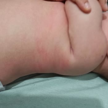 Bebem Natural Bebek Bezi Alerji Yaptı