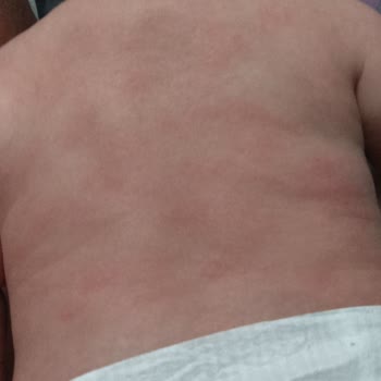 Bebem Natural Bebek Bezi Alerji Yaptı