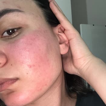 SHE Vec Serum Yüzümü Yaktı