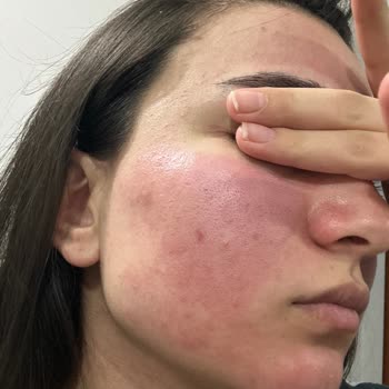 SHE Vec Serum Yüzümü Yaktı