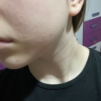 The Purest Solutions Salisilik Asit Cildimi Mahvetti