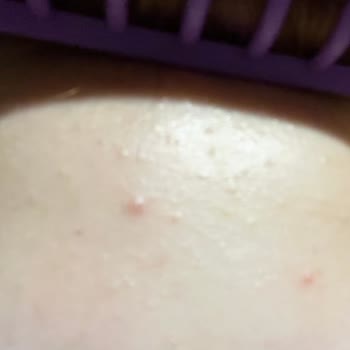 The Purest Solutions Salisilik Asit Cildimi Mahvetti