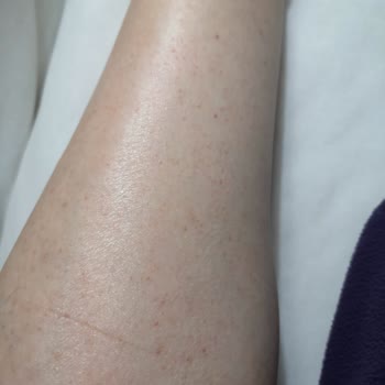 Rossmann Isana Med 10%Üre Vücut Sütü Ciddi Şekilde Alerji Yaptı