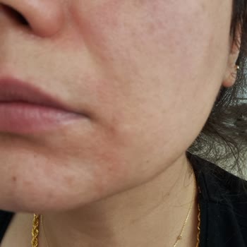 Garnier C Vitamini Serum Yüzümü Yaktı