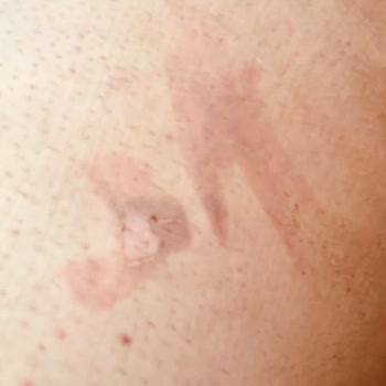 Esse Life Sinop Esse Life Firması Lazer Yaparken Vücudumu Yaktı