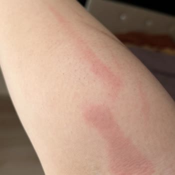 Esse Life Sinop Esse Life Firması Lazer Yaparken Vücudumu Yaktı