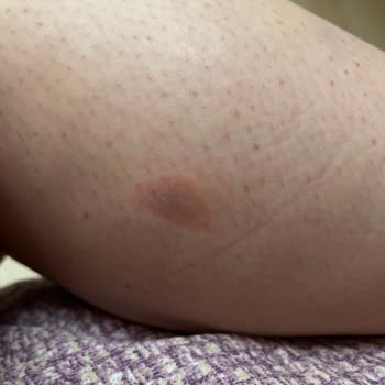 Esse Life Sinop Esse Life Firması Lazer Yaparken Vücudumu Yaktı