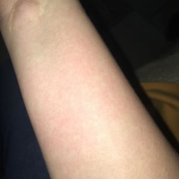 Bingo Vücudun Alerjik Tepkisi