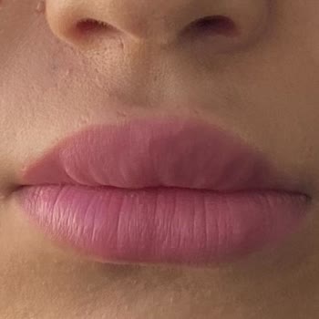 British Esthetic Dudak Dolgusu British