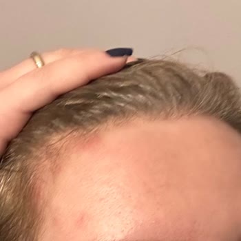 Bioderma Sebium Kerato + Sivilce Yaptı!