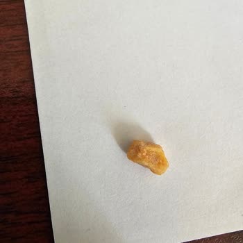 Ülker Pöti Dankek'te Çıkan Yabancı Cisim