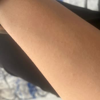 Loreal Paris Cilt Bakımı Sonrası Beklenmedik Tepki!