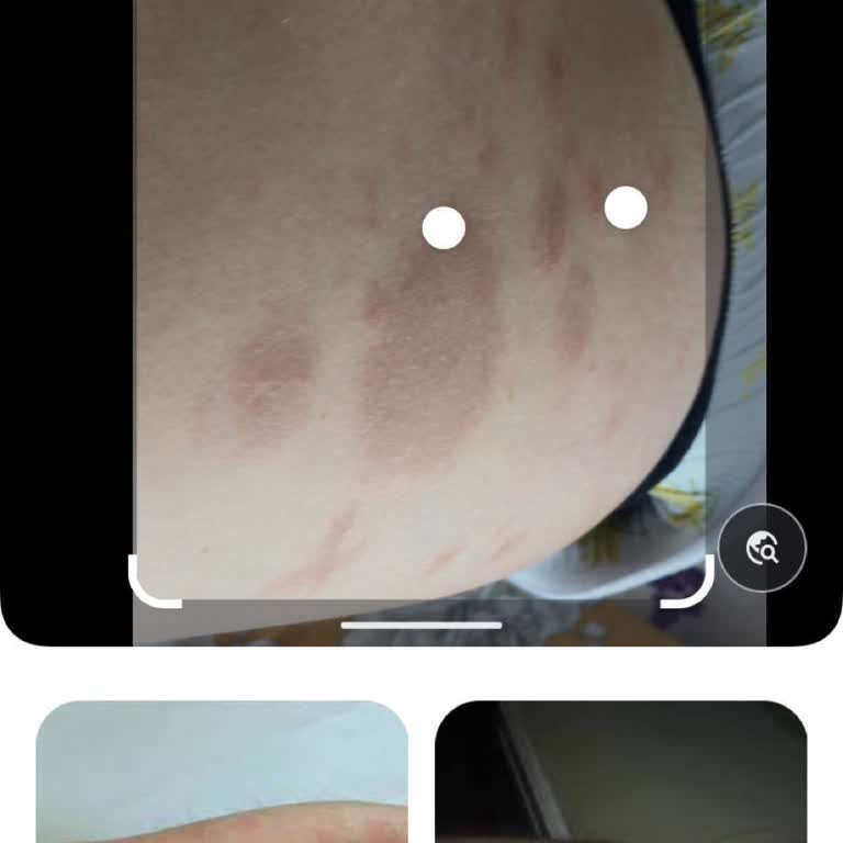 Doppel Herz Lupus Türü Lekeler Yaptı