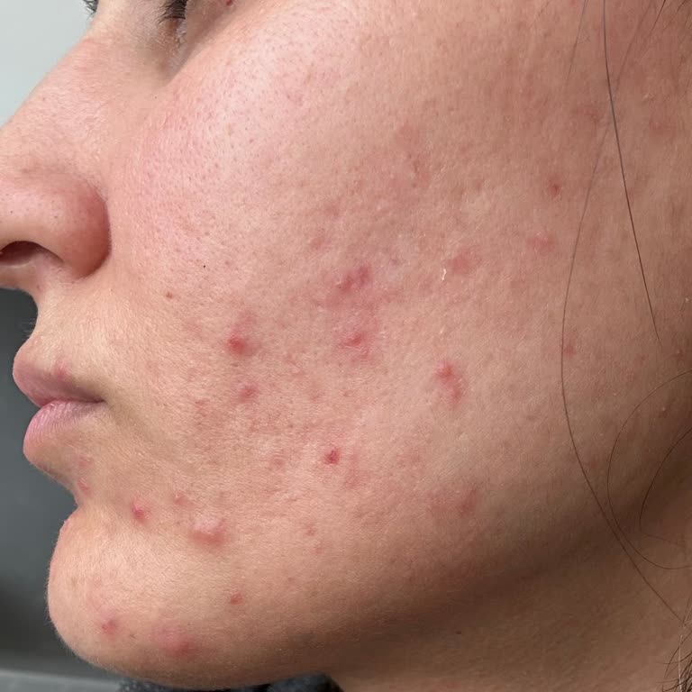 The Purest Solutions The Purest Sivilce Yaptı