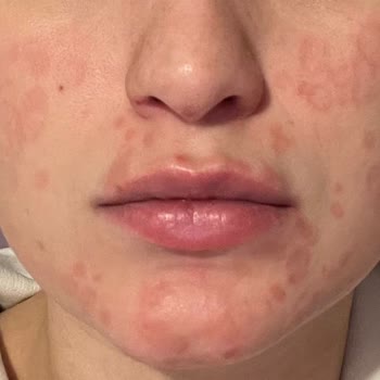 Uludağ Üniversitesi Tıp Fakültesi Hastanesi Üniversite Araştırma Hastanesindeki Dermatoloji Polikliniği Deneyimi