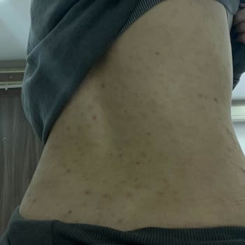 Uludağ Üniversitesi Tıp Fakültesi Hastanesi Üniversite Araştırma Hastanesindeki Dermatoloji Polikliniği Deneyimi