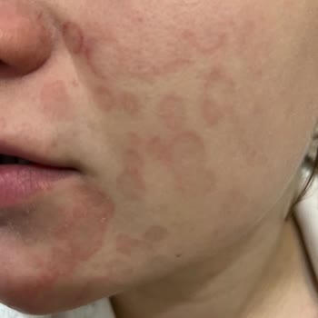 Uludağ Üniversitesi Tıp Fakültesi Hastanesi Üniversite Araştırma Hastanesindeki Dermatoloji Polikliniği Deneyimi