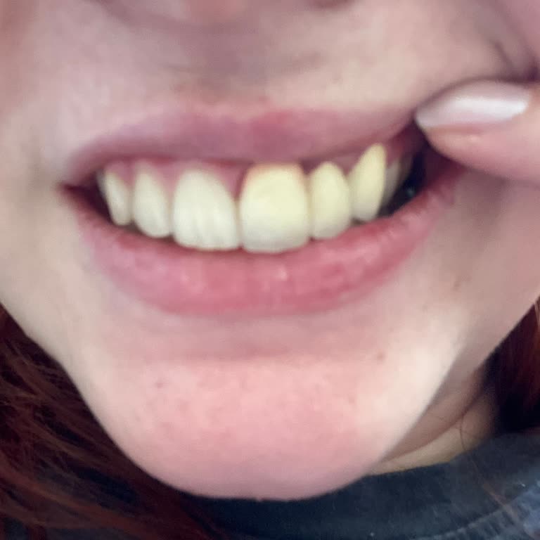 Dt. Veysel Koç Zirkon Kaplama Tedavisi