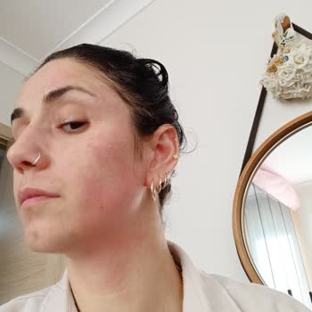 Bee Beauty Yüz Maskesiyle Gelen Kızarıklık Ve Tahriş!