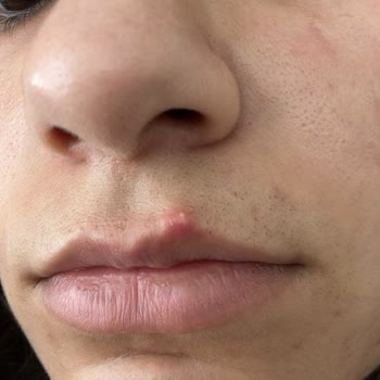 Acıbadem Bakırköy Lazer Epilasyon