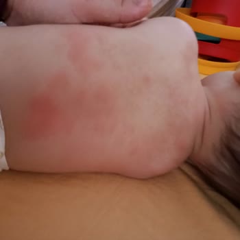Mustela İle Geçmeyen Kızarıklıklar
