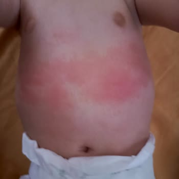 Mustela İle Geçmeyen Kızarıklıklar