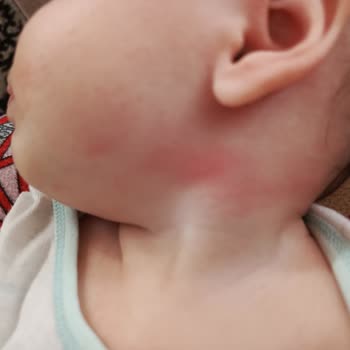 Mustela İle Geçmeyen Kızarıklıklar